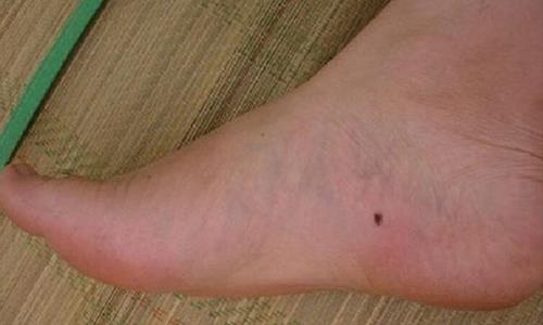 Nốt ruồi ở mép bàn chân