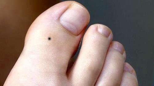 Nốt ruồi ở ngón chân cái